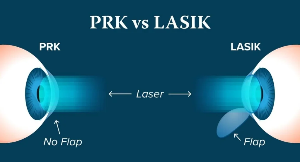 diferenças entre lasik vs prk