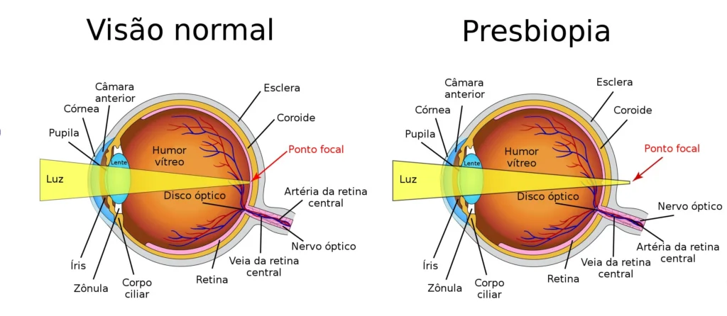 apresentação do que é a presbiopia na visão
